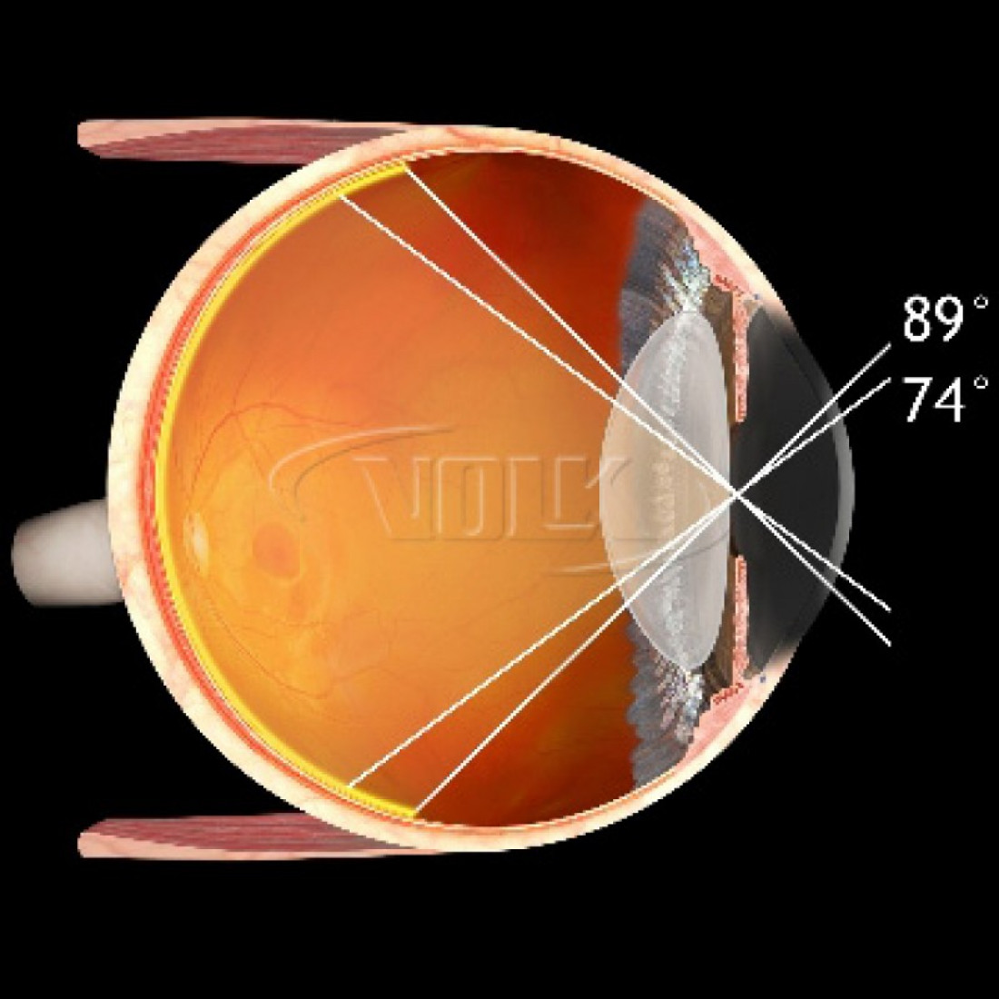 Офтальмоскопия линзой. Volk Pan retinal 2.2 линза. Линза для офтальмоскопа Volk Pan retinal 2.2. Линза Superfield Volk. Линза для обратной офтальмоскопии в 75 д.